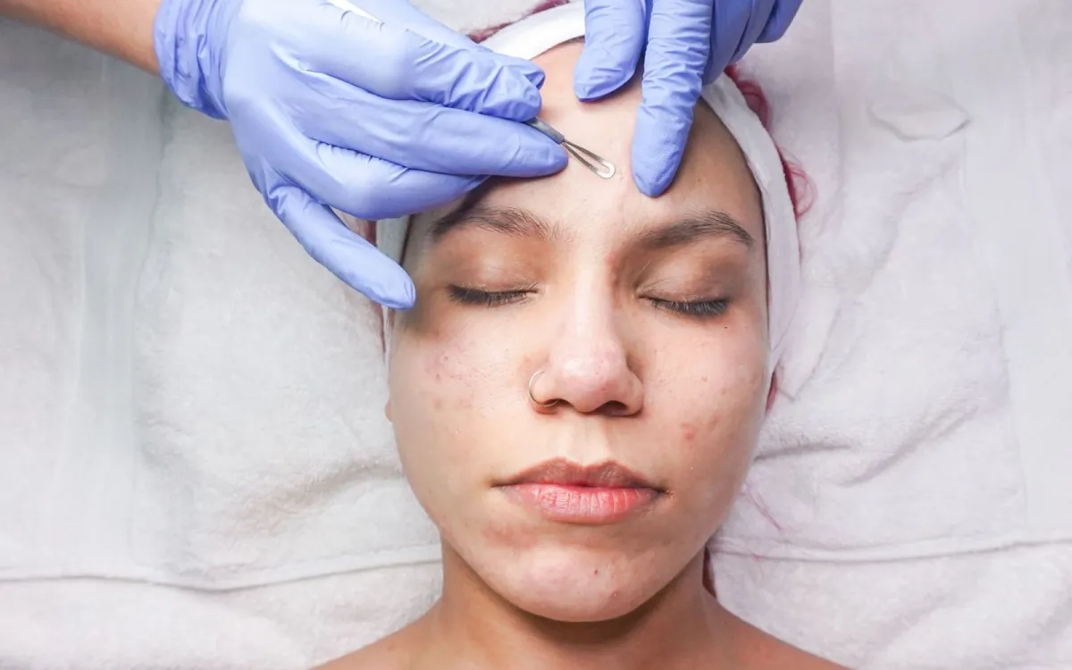 3 pertanyaan yang sering diajukan seputar klinik jerawat